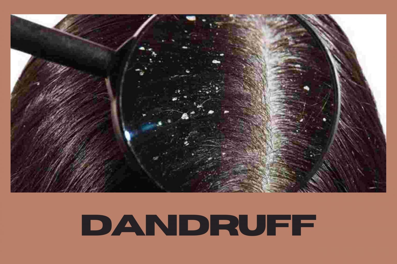 Dandruff - Fitness Beauty Art